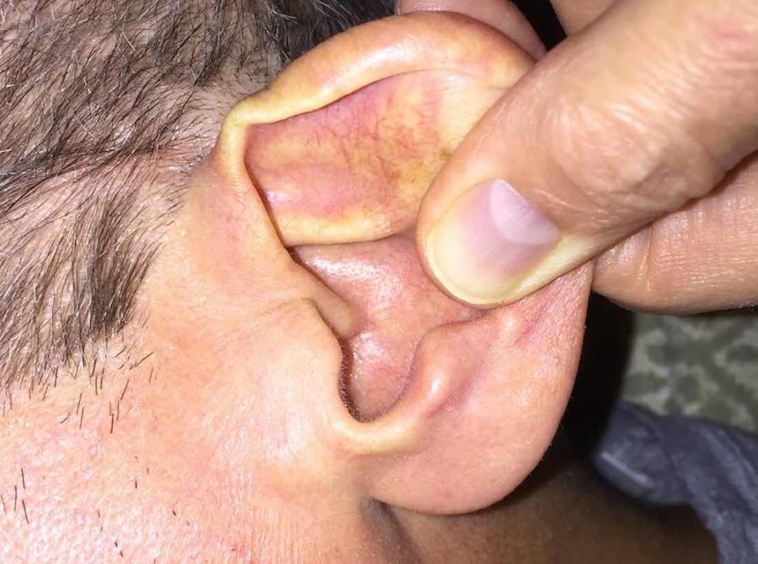 Help the softener work its way deeper by pulling on your earlobe.