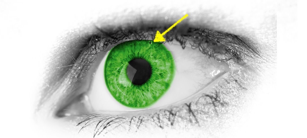 Example image of laser iridotomy