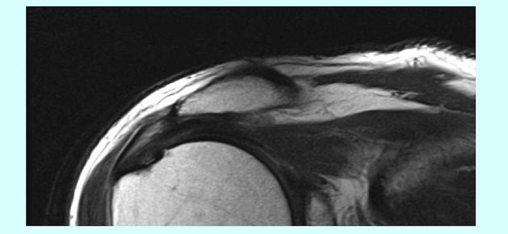 A section of the MRI scan showing my rotator cuff tear.