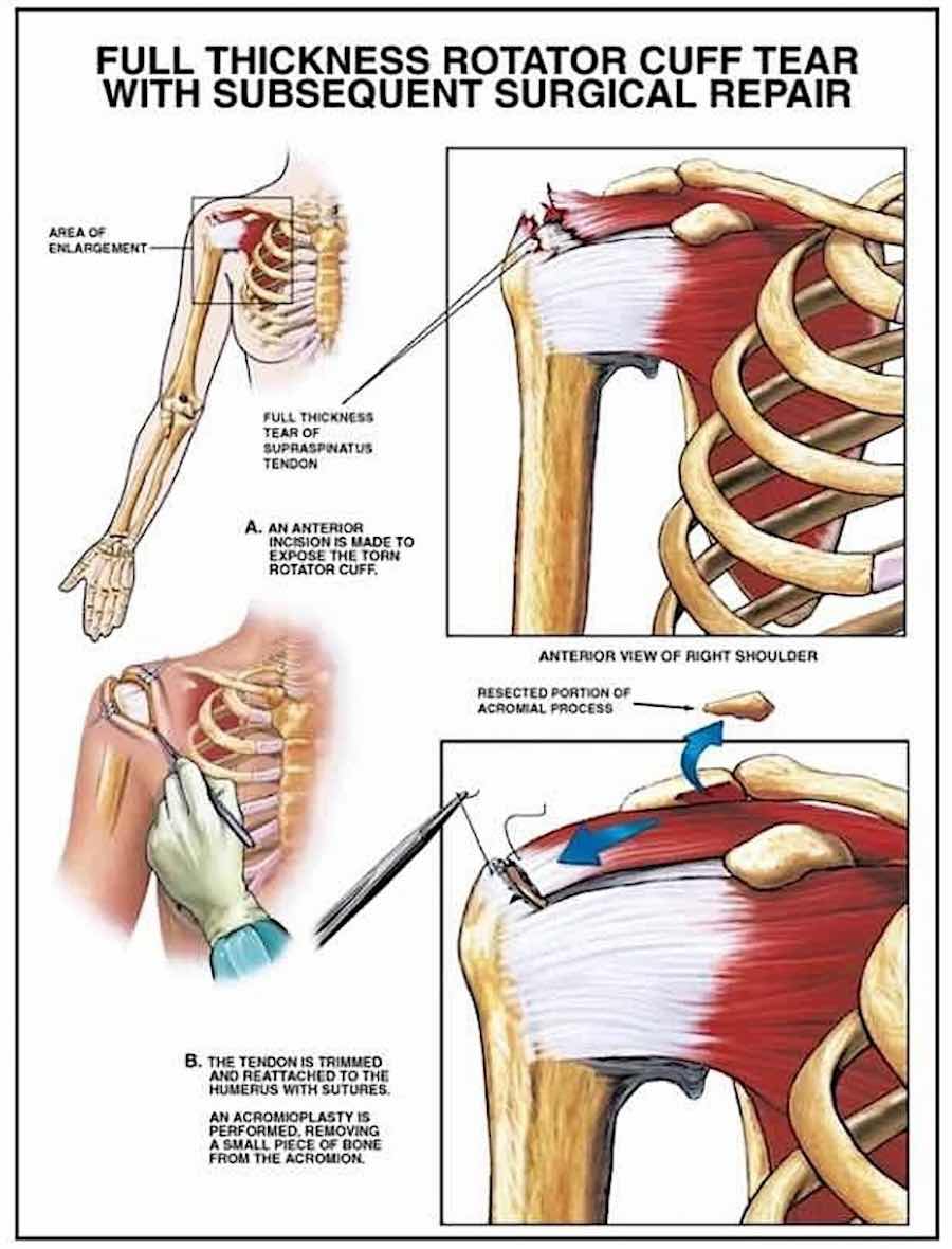 Surgical Repair Procedure of Rotator Cuff Tear