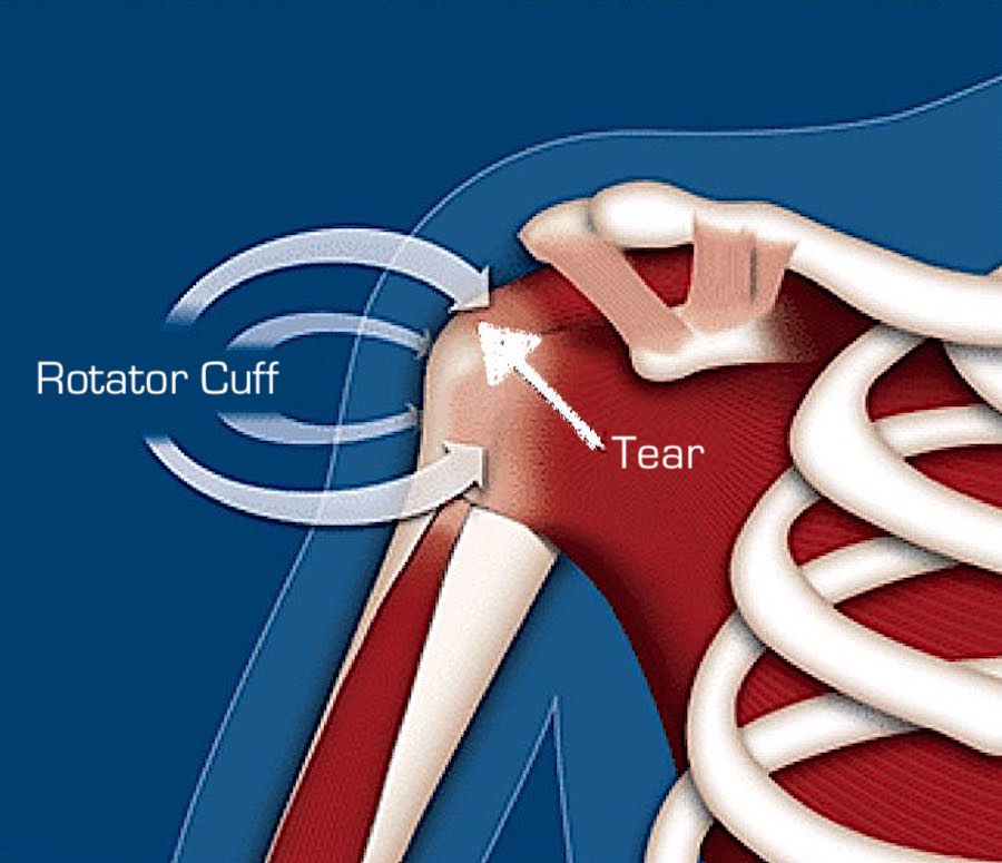 Rotator Cuff Tear in the Shoulder